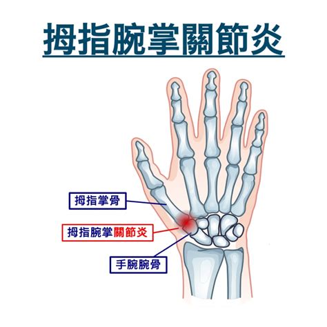 第一掌指關節|手部骨關節炎 